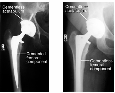 <p>Most commonly used prosthesis:</p><ul><li><p>Metal on polyethylene – ball is metal, socket is plastic or plastic lined (polyethylene)</p></li><li><p>Ceramic on polyethylene – ball is ceramic, socket is plastic or plastic lined (polyethylene)</p></li><li><p>Ceramic on ceramic - ball is ceramic, socket is ceramic lined</p></li><li><p>Ceramic on metal - ball is ceramic, socket is metal lined</p></li></ul><p></p><p>Day 0 → hip ROM, bridging, bed mobility</p><p>Day 1 → mobilize out of bed, rollator </p><p>Day 2 → sitting 30 mins initially depending on symptoms </p><p></p>