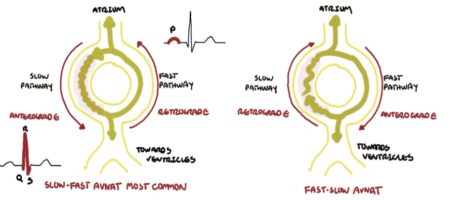 <p>A re-entrant SVT where the circuit loops in or around the AVN. This is because there are two pathways of varying speeds (one slower, one faster) in or around the AVN, and the impulse can travel backwards into the atria via one pathway (usually the fast one) from the other pathway (usually the slow one).</p>