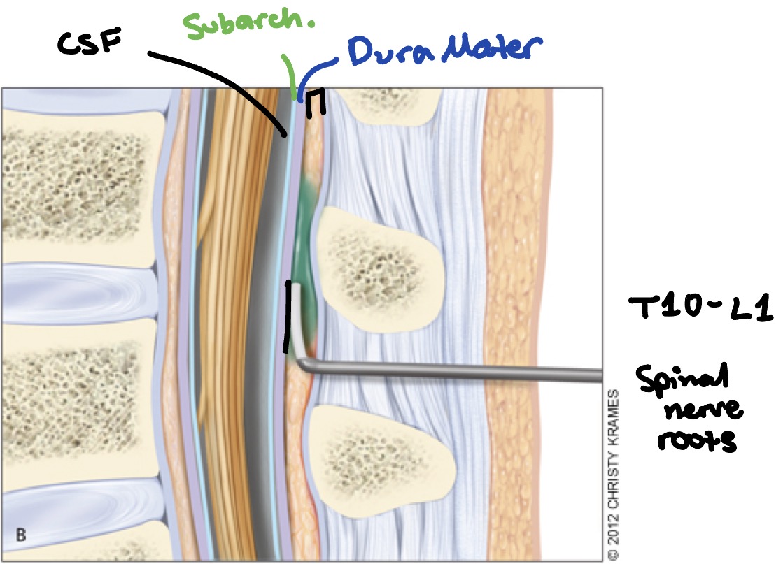 <p>T10-L1 </p><p>Spinal nerve roots</p>