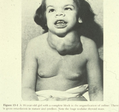 <p>An enlarged thyroid gland with two or more nodules suggests a metabolic rather than a neoplastic process. </p><p>Some thyroid cells are functioning more than others, and proliferating at different rates.</p>