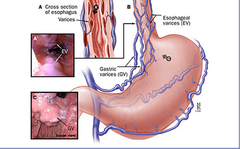 <p>-Dilated blood vessels in the lower third of the esophagus</p><p>-Strong association with portal hypertension, alcohol abuse, liver disease</p><p>-Risk for hemorrhage - eventual need for banding and/or resection</p>
