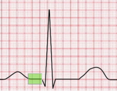 <p>electrical events monitored by the ECG occur just before mechanical events monitored by CVP waveform </p><p>-P wave = atrial depolarization</p><p>-"a" wave (CVP) = atrial contraction</p>