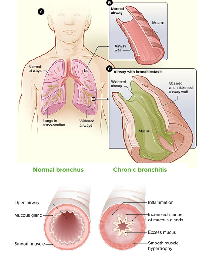 <p>Inflammation of the bronchi caused by infection or inhaled irritants. Has acute and chronic forms.</p>