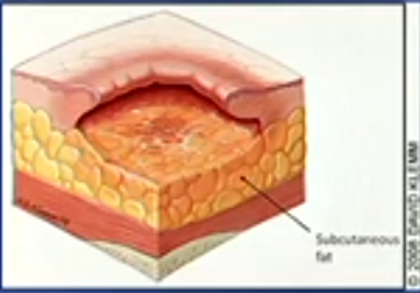 <p>full thickness skin loss</p><p>-adipose tissue is visible</p><p>-granulation tissue and rolled wound edges often present</p>