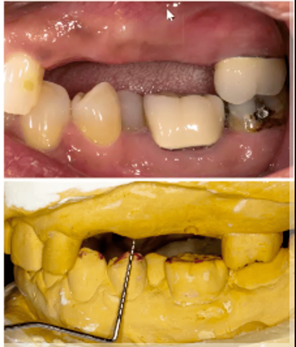 <p>Measurement from the gingiva to the opposing tooth</p>