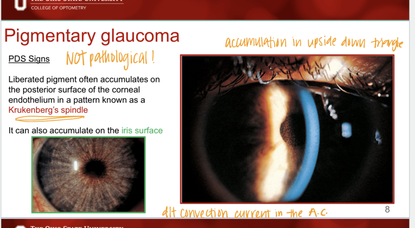 <p>Can pigment of PDS accumulate on the iris itself?</p>