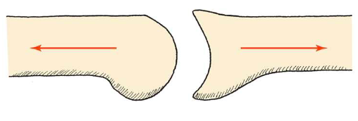 <p>Distraction or tension (ex. at your elbow, there can be a little traction if carrying a heavy suitcase)</p>