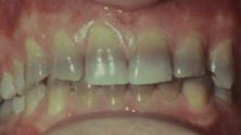 <p>from use during tooth development; may also discolor skin, sclera, thyroid; RX for acne, cystic fibrosis, RA</p>