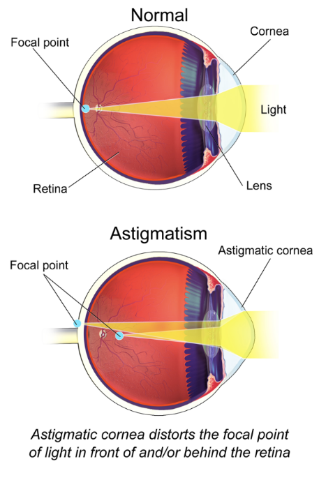 <ul><li><p>Occurs when light is not focused in a single spot on the retina, but has multiple focal points that may or may not be on the retina.</p></li><li><p>It is a result of irregular curvature of one or more of the focal structures of the eye, but mostly irregular curvature of the cornea</p></li></ul><p></p>
