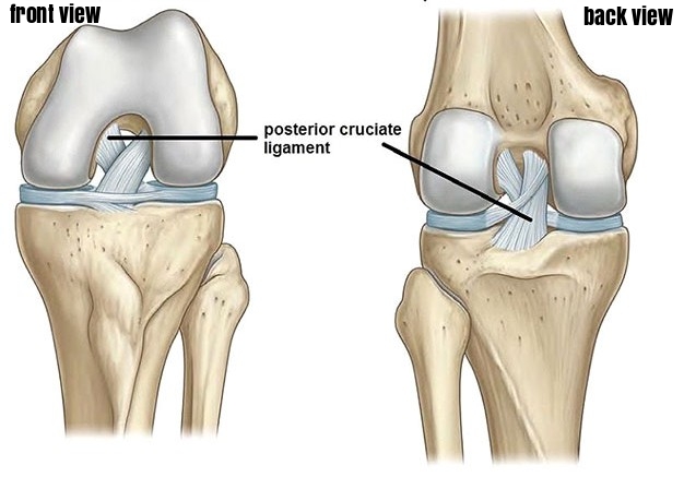 <p>Retained in cruciate-retaining designs, resected in posterior-stabilized; governs flexion stability and rollback.</p>