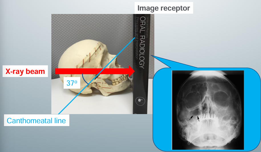 <p>-image receptor perpendicular to pt’s midsagittal plane</p><p>-pt faces image receptor and tilts head upward so the canthomeatal line forms a 37 degree angle with the image receptor</p><p>-head tilt position similar to head tilt when drinking water</p><p>-central x-ray beam positioned centered over the maxillary sinuses</p>