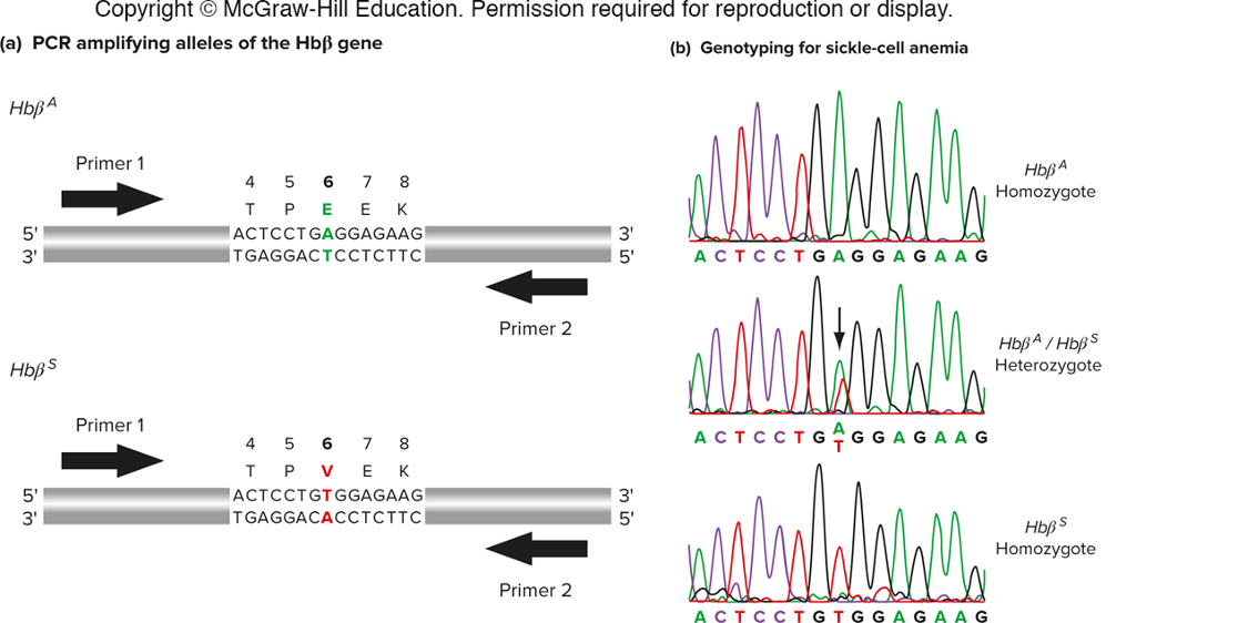 <p>sickle cell anemia is caused by a SNP in the Hb beta gene.</p><p>genotyping can identify carriers and homozygous individuals.</p><p>hetero - 2 peaks at same base (double peak)</p>