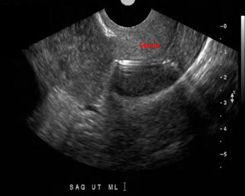 <p>The image of the cervix demonstrates which of the following?</p><p>A. Normal cervix with echogenic area due to perpendicular incidence with two layers of the cervical canal</p><p>B. Normal cervix with abnormal placement of an IUD</p><p>C. Normal cervix with normal placement of an IUD</p><p>D. Normal cervix with tampon inserted</p>