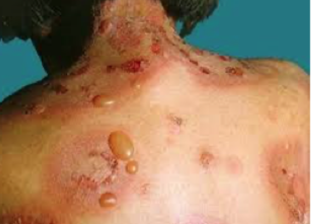 <p>Hvad er hovedpointen med sygdomseksemplet på desmosom-sliden?</p>