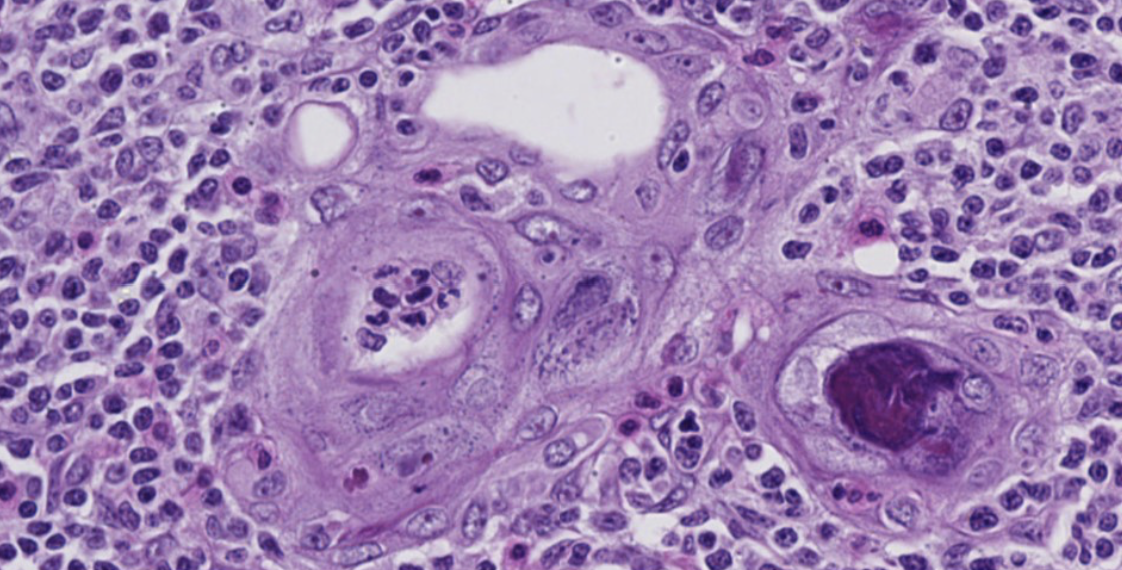 <p><span>Which of the following is FALSE about the image below?</span></p><p><span>-</span>It is in the thymus cortex</p><p>-It contains more mature thymocytes that are less densely packed</p><p>-It contains Hassall’s Corpuscles that are concentric layers of epithelial reticular cells that are degenerating</p><p>-It contains dendritic antigen-presenting cells</p>