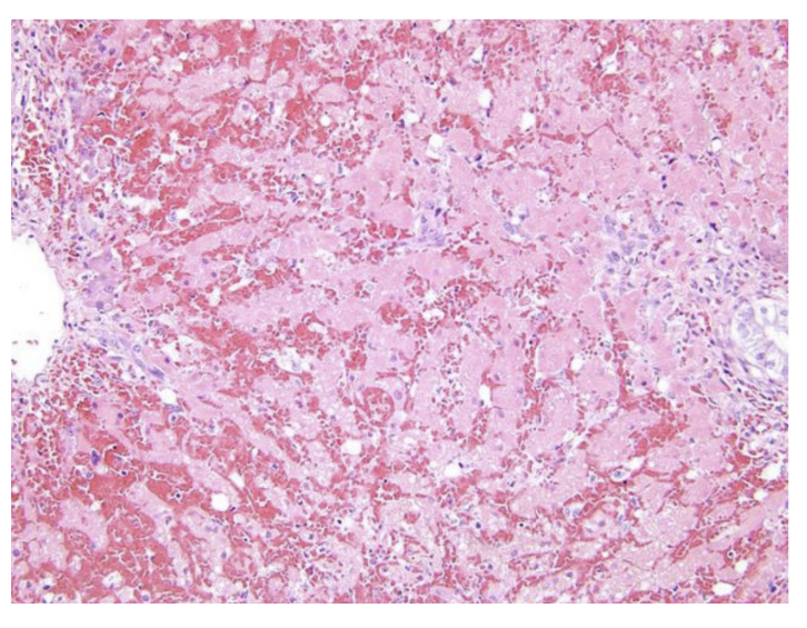 <p>Complete (Massive) or near complete (Sub-massive) destruction of hepatocytes affecting almost the whole liver</p>