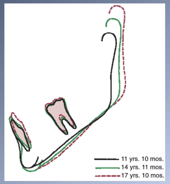 <p><span>ERUPTION PATH OF MANDIBULAR TEETH is upward and slightly forward.</span><br><span>- Normal internal rotation carries the jaw upward in front</span><br><span>- Uprights incisors</span></p>