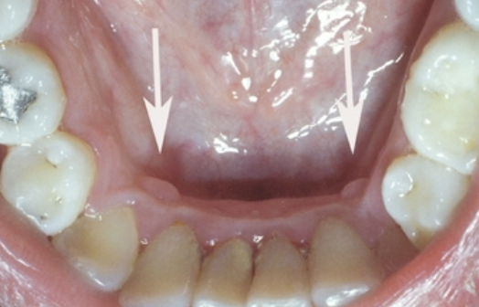 <p>a sessile nodule on the gingival margin of the lingual aspect of the mandibular cuspids</p>