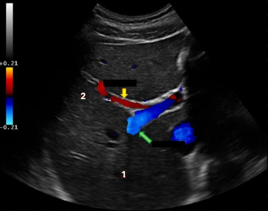 <p>What liver vessel is indicated by the yellow arrow? </p><p>a. anterior right portal vein</p><p>b. medial left portal vein</p><p>c. posterior right portal vein</p><p>d. lateral left portal vein</p>