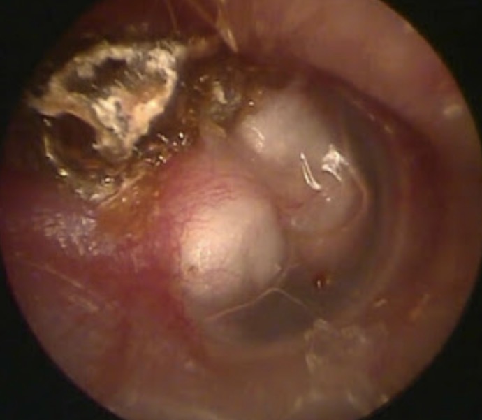 <p><span>•Benign skin growth in the middle ear cavity</span></p><p class="s83"><span>•Bad cases can destroy ossicles (or require surgery that destroys ossicles)</span></p><p class="s83"><span>•Loss of ossicles can create a ~60-dB hearing loss</span></p><p class="s163"><span>•</span><em><span>Loss of ~35-dB gain from ossicle transforms</span></em></p><p class="s180"><span>•</span><em><span>Loss of ~25-dB gain from lack of differential pressure input to the oval and round windows of the cochlea</span></em></p>