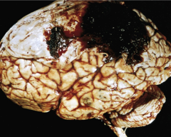 <p>What is the classic course of an epidural hematoma?</p>