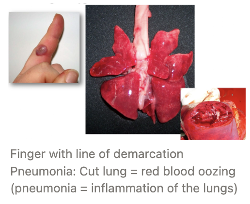 <p><u>Definition:</u> More blood to tissues due to increased arterial blood flow and more reserve capillaries flowing with blood</p><ul><li><p>Usually an acute, active processes associated with inflammation</p></li></ul><p><u>Appearance:</u> Bright red tissues from accumulation of oxygenated Hb</p><p><u>Aetiologies:</u></p><ol><li><p><strong>Physiological hyperaemia</strong></p><ol><li><p>Increased arterial blood flow in the stomach and intestine during digestion</p></li><li><p>Exercise increases hyperaemia to muscles</p></li></ol></li><li><p><strong>Pathological hyperaemia</strong> = Hyperaemia as a result of inflammation</p></li></ol><p></p>