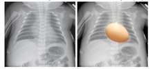 <p>CXR findning of TGA</p>