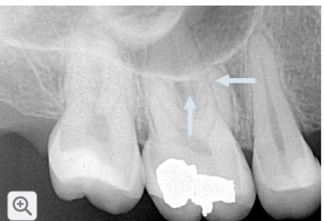 <p>what are the maxillary sinus?</p>