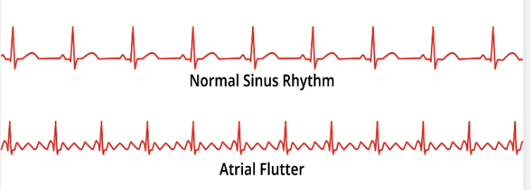 <ul><li><p>what</p><ul><li><p>rapid atrial activity of 300 bpm</p></li><li><p>HR sometimes shows up normal if ventricular rate is normal</p></li><li><p>symp: palpitations, fatigue, lightheadedness, SOB, exercise intolerance, hypotension, syncope</p></li><li><p>EKG: </p><ul><li><p>sawtooth P wave</p></li><li><p>rate 250-450</p></li></ul></li></ul></li></ul><p></p>