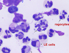 <p>This is joint fluid taken from an older cat. Describe what you see</p><p>1. inflammatory or noninflammatory?</p><p>Note: ragocytes are neutrophils in synovial fluid that contains cytoplasmic inclusions</p>