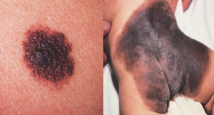 <p>mongolian spot (congenital dermal melanocytosis): benign, flat congenital birthmark w/ wavy borders + irregular shape (pictured above)</p><p>entrapment of melanocytes in the lower half to 2/3 of dermis</p><p>harmless and usually fade by school age</p>