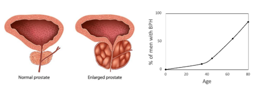 <p>Enlargement of prostate gland due to cell proliferation</p><p>Age related </p><p>non-cancerous</p>
