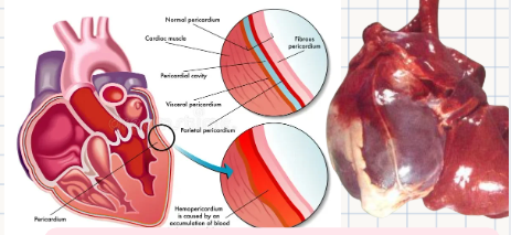 <p>Accumulation of <strong>whole blood</strong> in the <strong>pericardial sac</strong> ("BLOOD AROUND THE HEART").</p>
