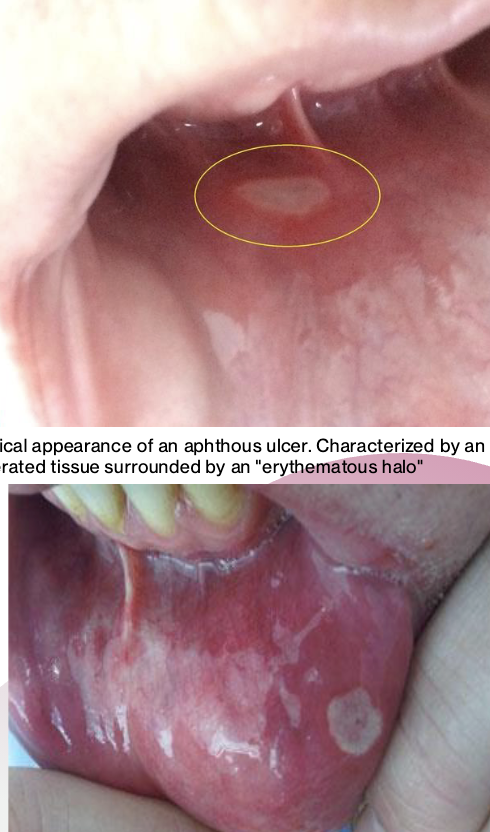 <p><strong>Complication</strong> – Pt develops an aphthous ulcer (canker sore) near site of local anesthetic deposition</p>