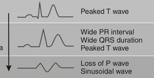 <p>the image shown depicts progressive EKG abnormalities that are consistent with what condition?</p>