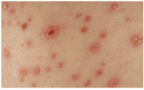 <p><span>A person who developed the skin rash shown at right might</span></p><p class="MsoNormal"><span>have what complication later on?</span></p>