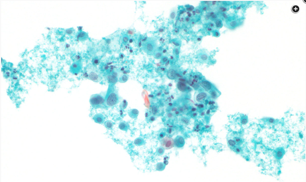 <p>What is the squamous abnormality seen on this Pap smear?</p>