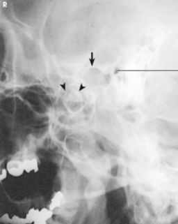 <p><span style="background-color: transparent;">TMJ SCHULLER: open or closed?</span></p>