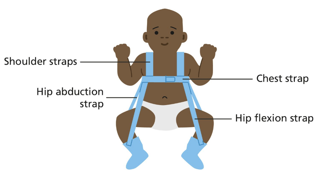 <p>A brace that keeps an infant’s hips flexed and abducted to treat DDH and maintain proper hip alignment </p>