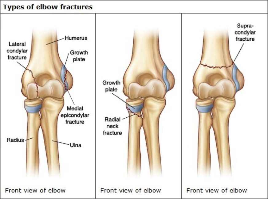 <p>elbow fracture</p>
