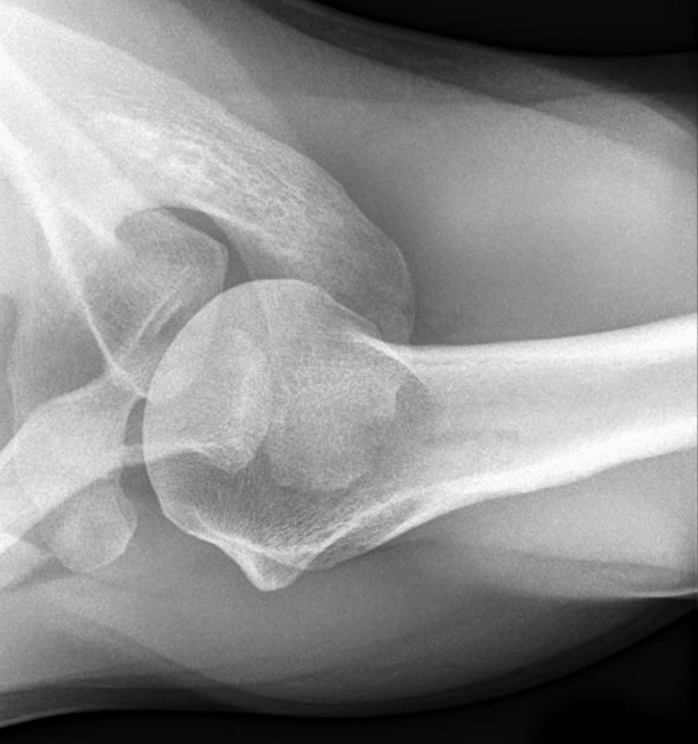<p>correct position is evidenced by anterior and posterior rims of glenoid cavity are superimposed </p>