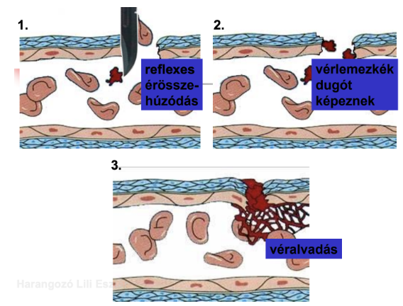 <ul><li><p style="text-align: justify;"><span style="background-color: transparent;">Lényege: a plazmában lévő oldott fibrinogén átalakulása oldhatatlan fibrinné, ami stabil vérrögöt hoz létre a sérült érfalon</span></p></li></ul><p style="text-align: justify;"><span style="background-color: transparent;"><strong>4 fő fázisa</strong></span></p><ol><li><p style="text-align: justify;"><span style="background-color: transparent;">Érösszehúzódás</span></p></li><li><p style="text-align: justify;"><span style="background-color: transparent;">Vérlemezke fázis („fehér trombus”)</span></p></li><li><p style="text-align: justify;"><span style="background-color: transparent;">Véralvadék képződés („vörös trombus”)</span></p></li><li><p style="text-align: justify;"><span style="background-color: transparent;">Véralvadék lebontása</span></p></li></ol><ul><li><p style="text-align: justify;"><span style="background-color: transparent;">Fibrinháló + fennakadt sejtes elemek → véralvadék (stabil vérrög)</span></p></li><li><p style="text-align: justify;"><span style="background-color: transparent;">Kiszűrődő folyadék → vérsavó (nem tartalmaz fibrint)</span></p></li></ul><p style="text-align: justify;"><span style="background-color: transparent;"><strong>Vérzékenység (hemofília)</strong></span></p><ul><li><p style="text-align: justify;"><span style="background-color: transparent;">Mutáció: X kromoszóma</span></p></li><li><p style="text-align: justify;"><span style="background-color: transparent;">Egy vagy több véralvadási faktor hiánya</span></p></li><li><p style="text-align: justify;"><span style="background-color: transparent;">Mo: kb. 3000 beteg</span></p></li></ul><p><span style="background-color: transparent;"><strong>Trombózis</strong></span></p><ul><li><p style="text-align: justify;"><span style="background-color: transparent;">Kóros vérrögképződés, erek elzáródása</span></p></li><li><p style="text-align: justify;"><span style="background-color: transparent;">Komplikációk: tüdő- és agyembólia (stroke)</span></p></li></ul><p></p>