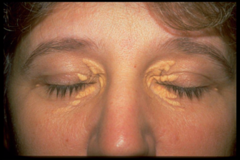 <p>slightly raised, yellowish, and well-circumcized plaques that appear along the nasal portions of the eyelids</p>