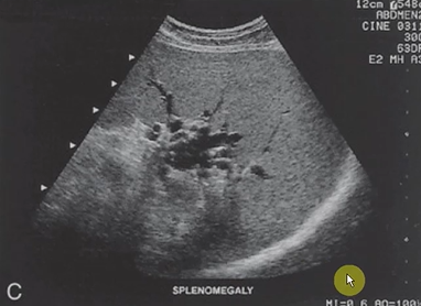 <p>What are the sonographic findings with splenomegaly?</p>