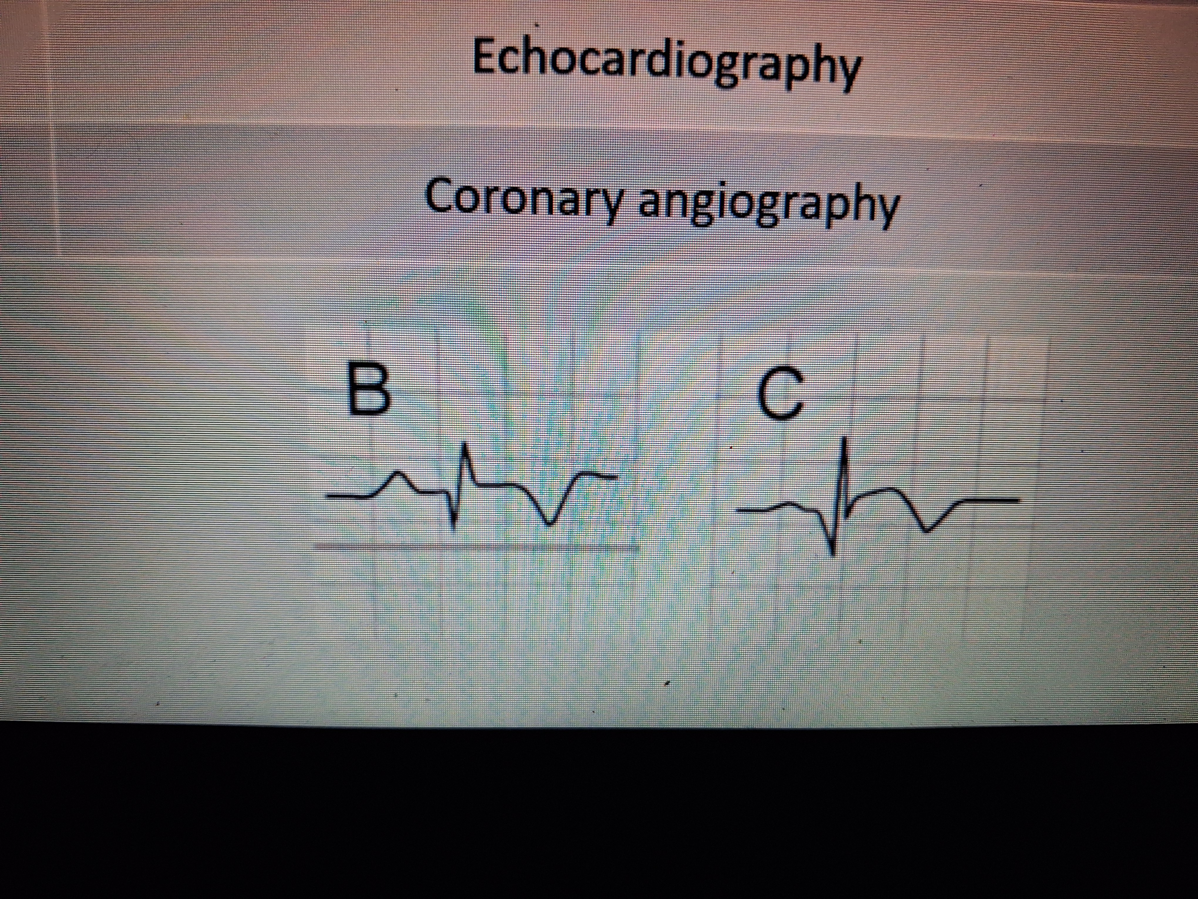 <p>T wave inversion</p><p class="has-focus">ST segment elevation</p><p class="has-focus">Formation of Q wave</p>