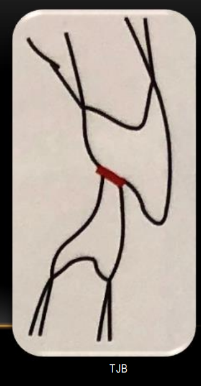 <p>-establish centric holding stops (first rule of occlusion)</p>