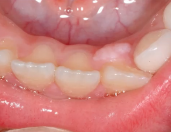 <p>pedunculated or sessile nodule in YOUNGER age group</p>