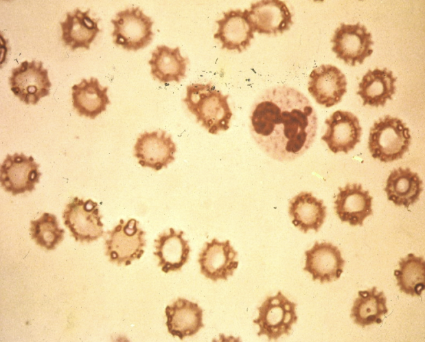 <p>RBCs look moth eaten or as burr cells</p>