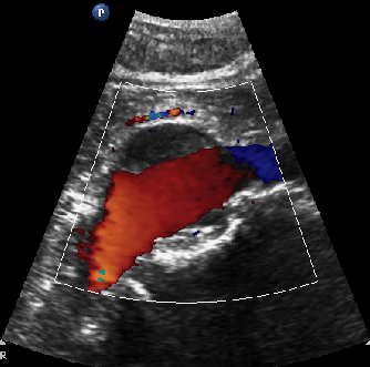 <p><span>It demonstrates the residual flowing lumen and helps distinguish flowing blood from thrombus.</span></p>