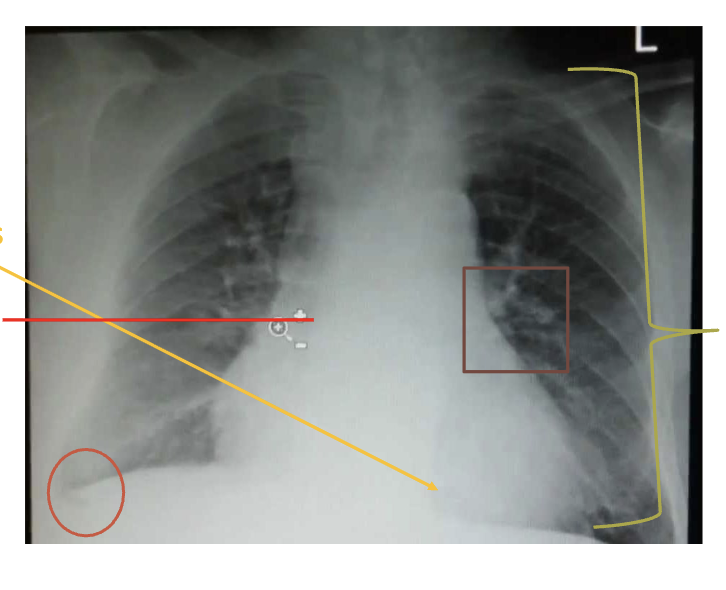 <p>see hyperexpansion (more than 10 ribs seen, barrel chest), flattened diaphragm, cardiomegaly, cystic changes, irregular air pockets, costophrenic angle changes</p>